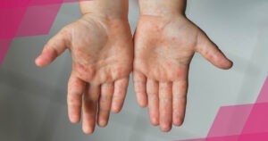 Вірус Коксаки або синдром "рука-нога-рот"